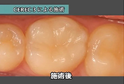 セレック治療症例写真 治療後