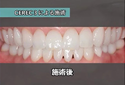 セレック治療症例写真 治療後